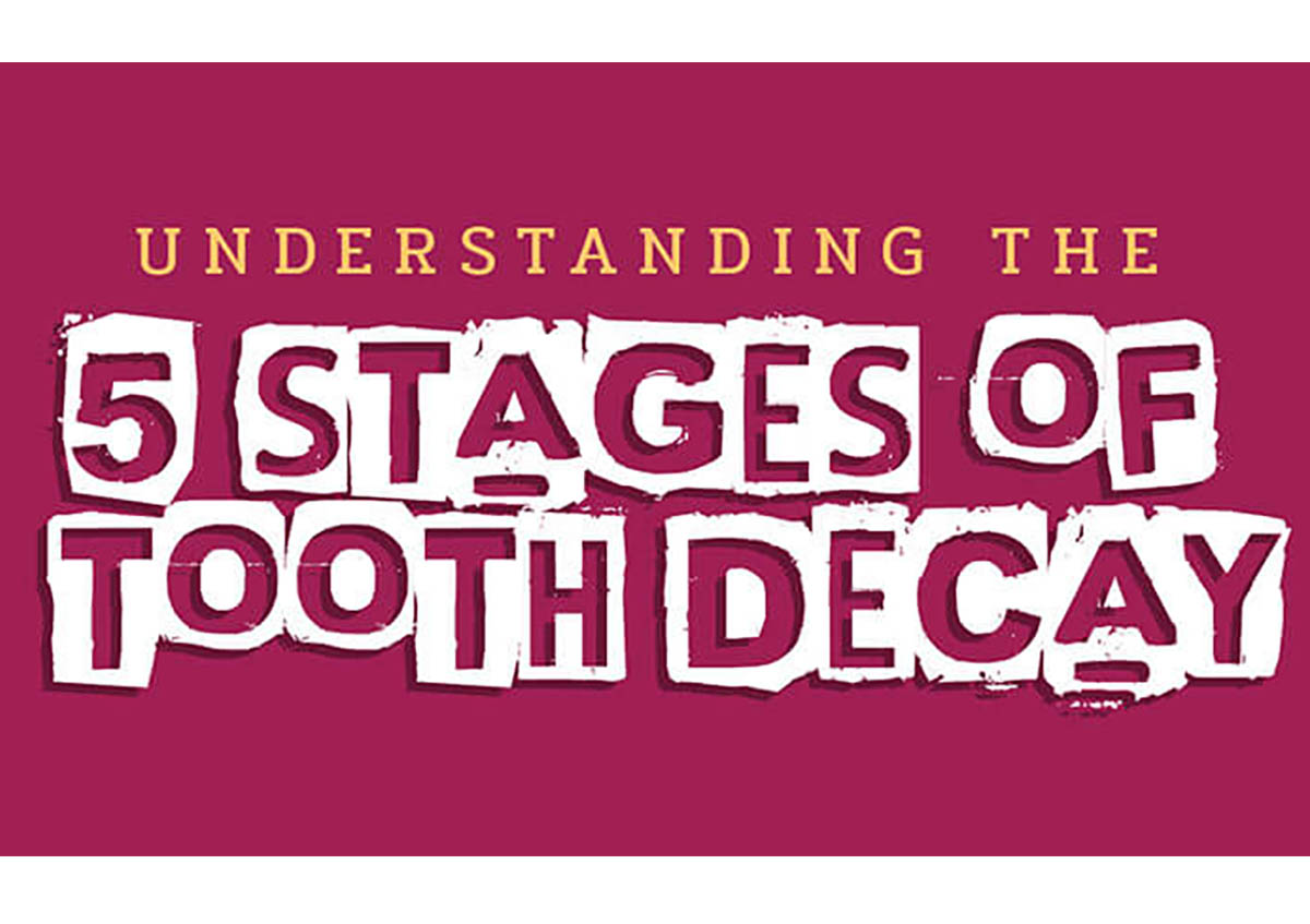 Understanding the Five Stages of Tooth Decay