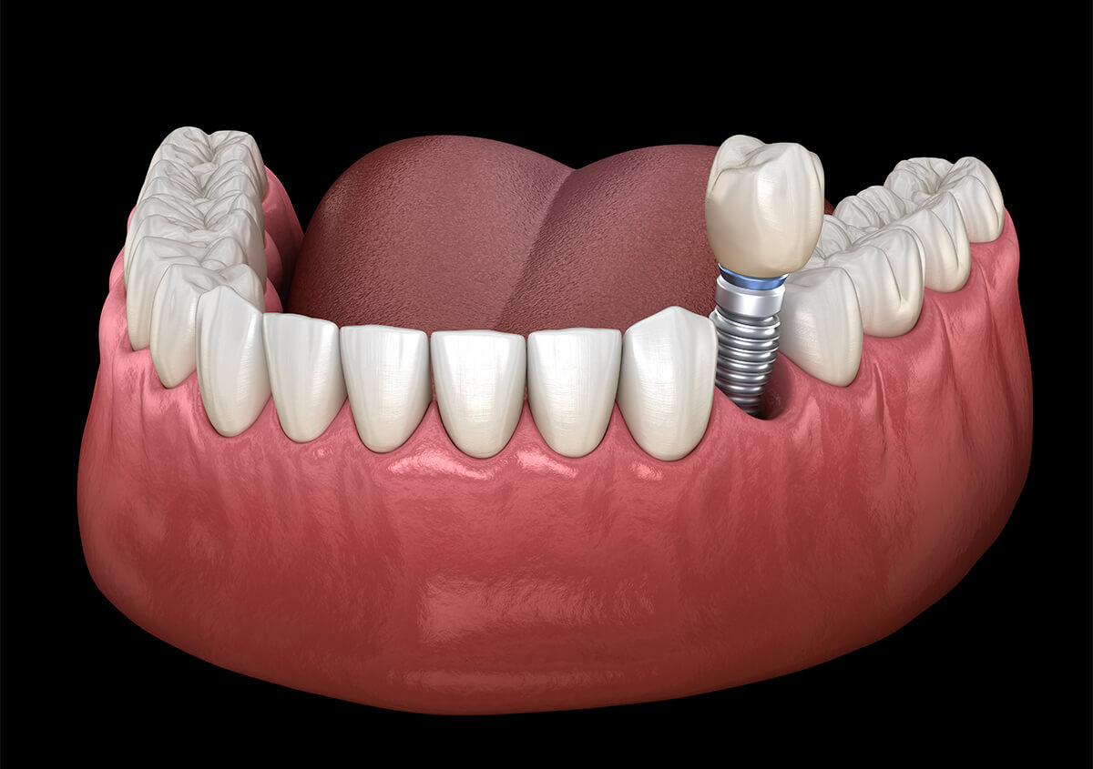 Dental Implant Surgery in Toms River NJ Area