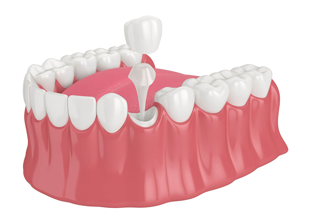 How Long Do Tooth Crowns in Last Toms River NJ Area